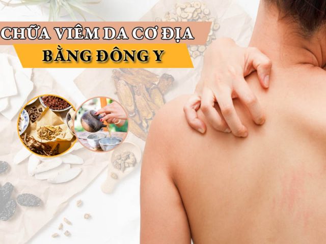 Chữa viêm da cơ địa bằng thuốc đông y