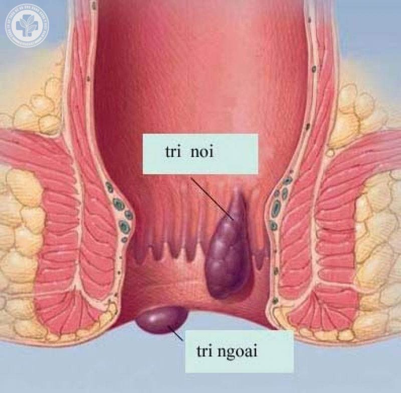 Táo bón dẫn tới bệnh trĩ