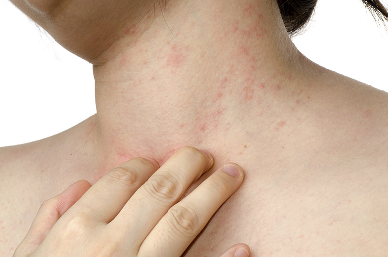 Bệnh viêm da cơ địa là một dạng tổn thương da kéo dài, gây ra nhiều khó chịu cho người bệnh