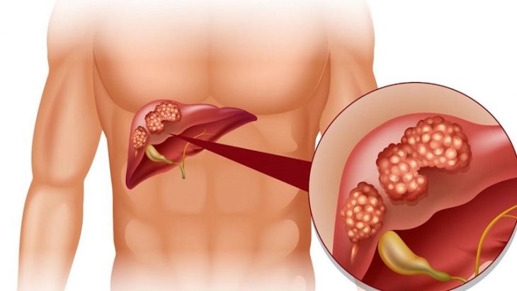 Viêm gan do một số loại virus gây ra