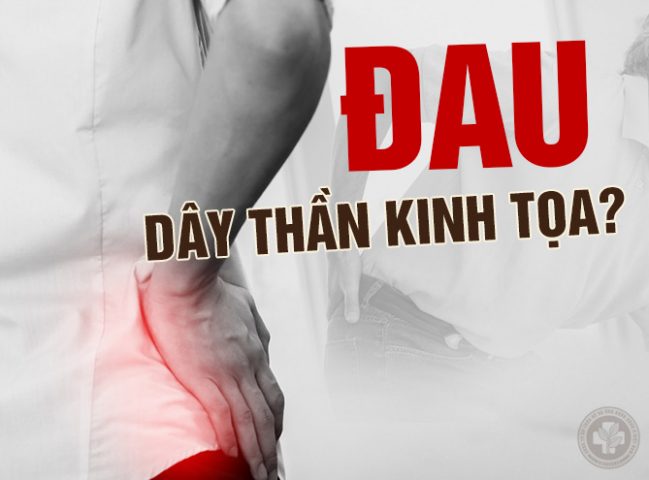 Đau dây thần kinh tọa là bệnh xương khớp thường gặp