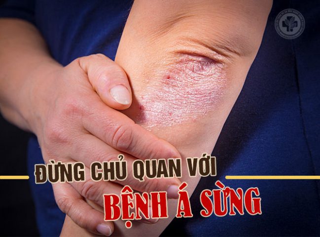 Đừng chủ quan với bệnh á sừng