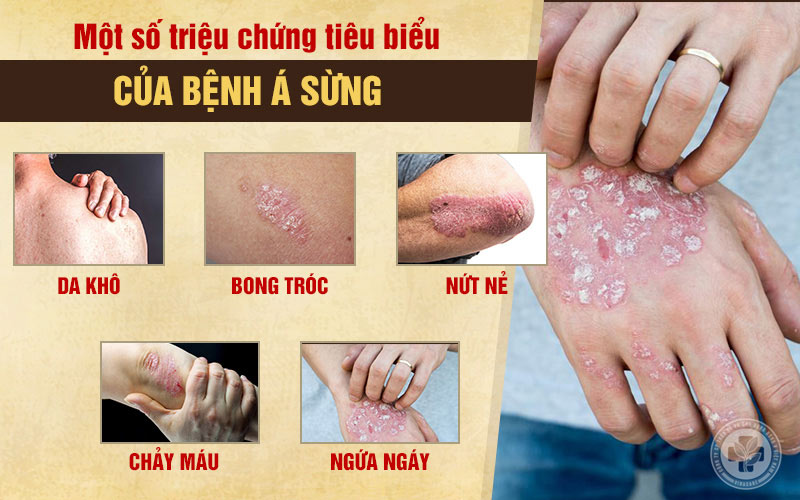 Triệu chứng tiêu biểu của bệnh á sừng