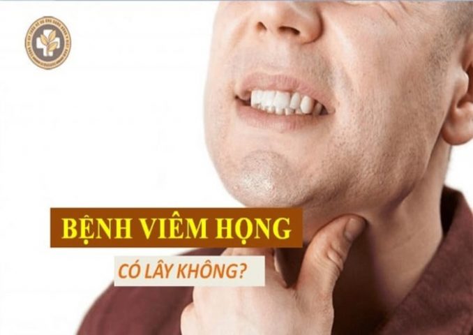 Bệnh viêm họng có lây không?