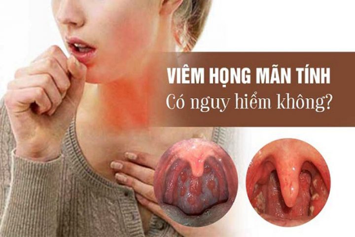 Viêm họng mãn tính có nguy hiểm không? Những lưu ý để bệnh nhanh khỏi