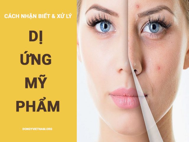 Dị ứng mỹ phẩm - Làm đẹp mà không đẹp