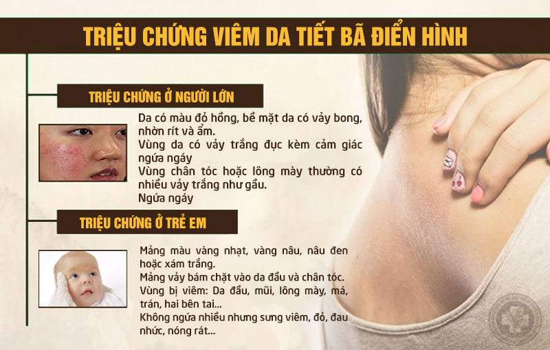 Triệu chứng nhận biết viêm da dầu ở trẻ em và người lớn 