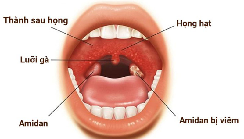 Viêm amidan là bệnh lý phổ biến hiện nay