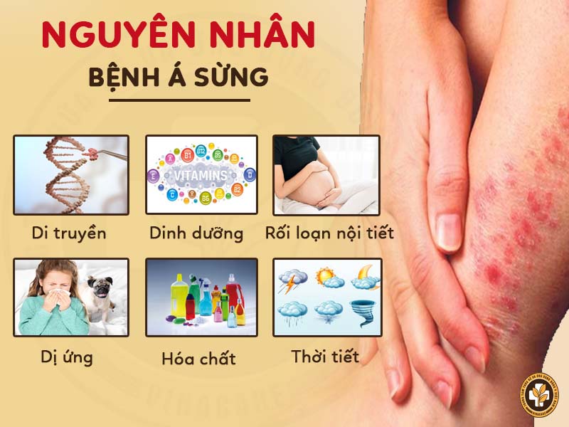 Một số nguyên nhân gây bệnh á sừng