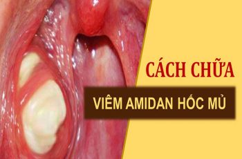 Cách trị viêm amidan hốc mủ