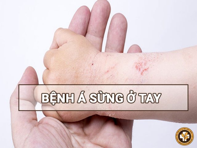 Bệnh á sừng bàn tay ngón tay