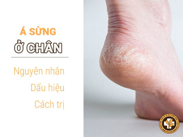 Bệnh á sừng ở chân