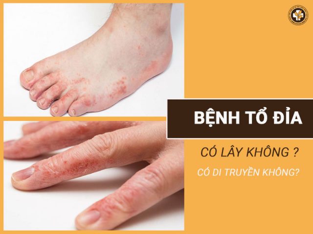 Bệnh tổ đỉa có lây không