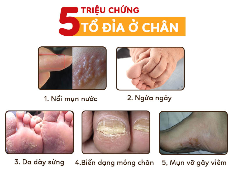 Những dấu hiệu có thể gặp khi chân bị tổ đỉa