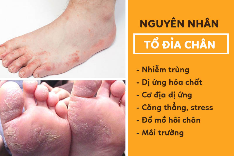 Những nguyên nhân có thể khiến chân bạn bị tổ đỉa