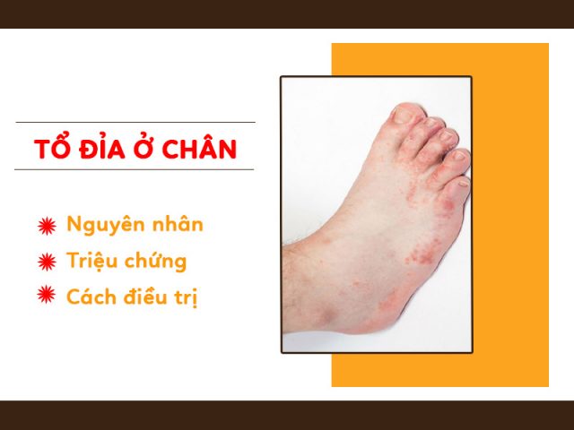 Bệnh tổ đỉa ở chân