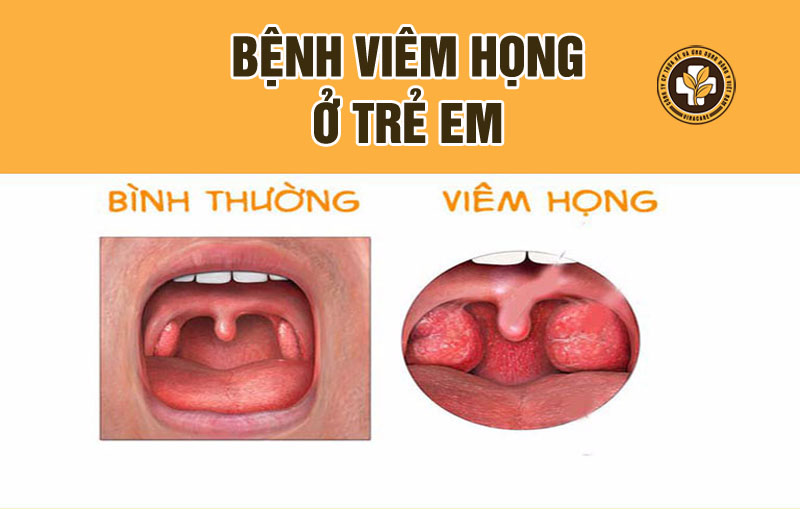 Bệnh viêm họng ở trẻ em