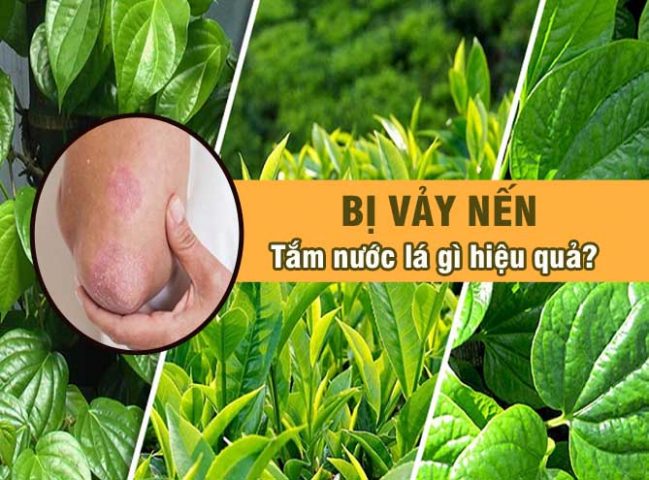 Bị vảy nến tắm nước lá gì