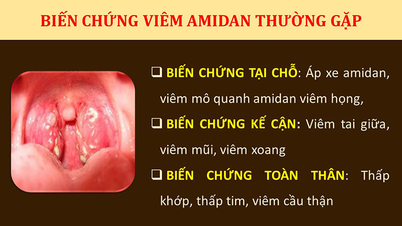 Viêm amidan hốc mủ có nguy hiểm không? 