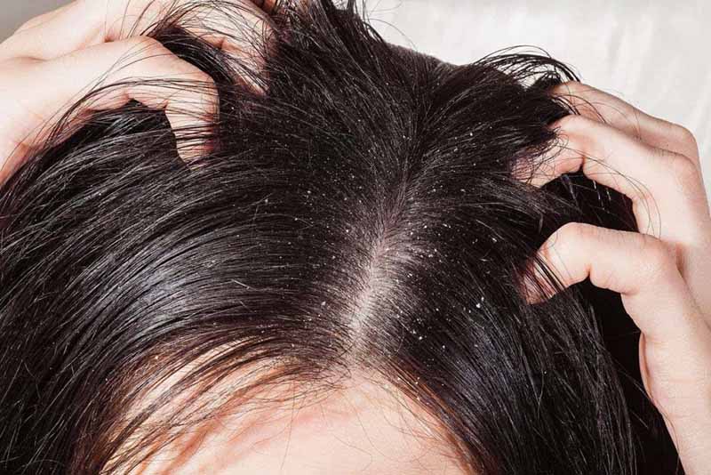 Cách chữa vảy nến da đầu tại nhà chỉ phù hợp với những trường hợp bệnh nhẹ