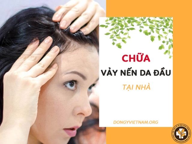 Cách chữa vảy nến da đầu tại nhà