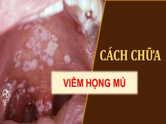 Cách chữa viêm họng mủ trắng