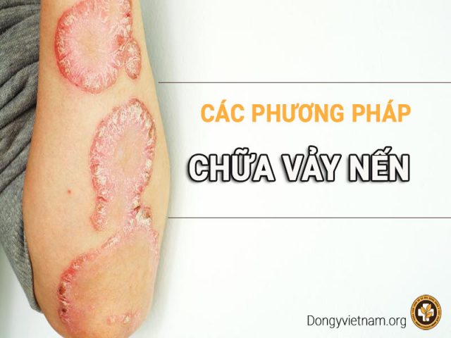 Cách điều trị vảy nến