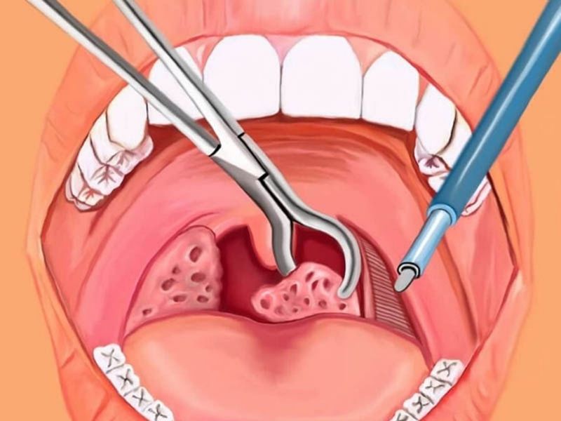 Trong khi cắt amidan người bệnh sẽ không cảm thấy đau đớn