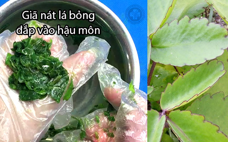 La bỏng thường được sử dụng trị bệnh trĩ