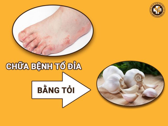 Chữa bệnh tổ đỉa bằng tỏi