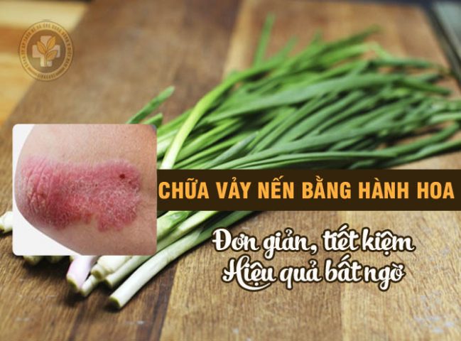 Chữa vảy nến bằng hành hoa