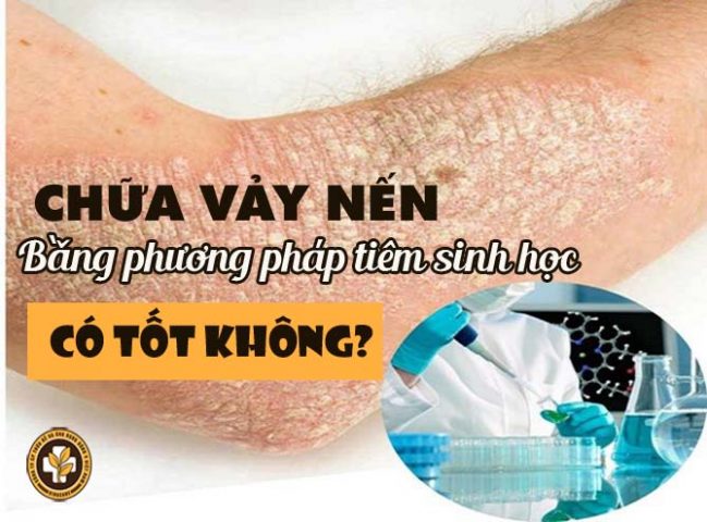 Chữa vảy nến bằng phương pháp tiêm sinh học