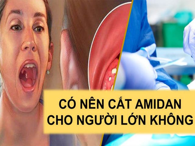 Có nên cắt amidan cho người lớn không