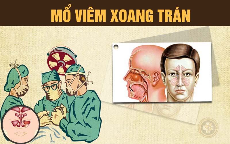 Có nên mổ viêm xoang trán