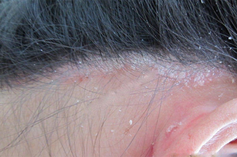 Vảy nến da đầu