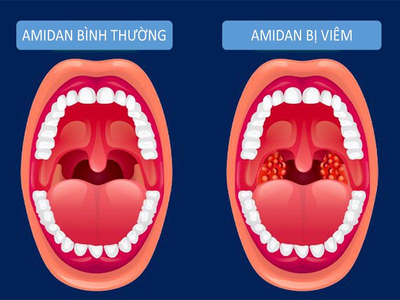 Hình ảnh amidan bình thường và amidan bị viêm