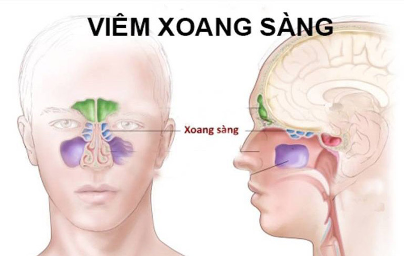 Hình ảnh viêm xoang sàng