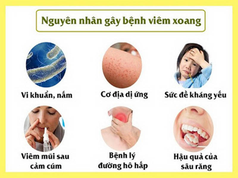 Nguyên nhân viêm xoang cấp