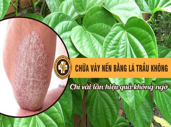 Trị vảy nến bằng lá trầu không