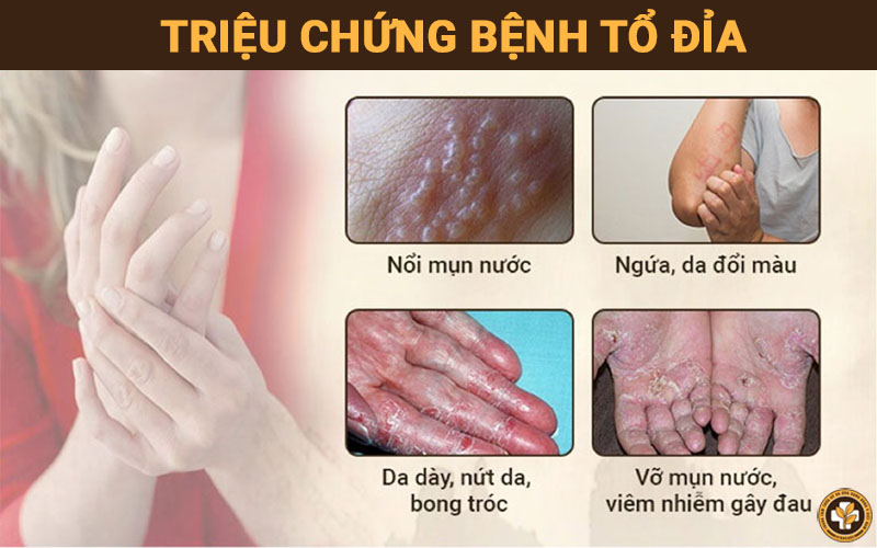 Những triệu chứng bệnh tổ đỉa thường gặp