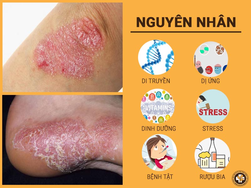 Một số nguyên nhân gây ra vảy nên á sừng