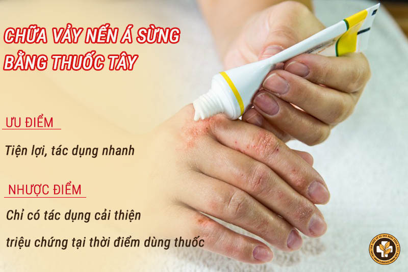 Ưu nhược điểm của thuốc Tây chữa bệnh vảy nến á sừng