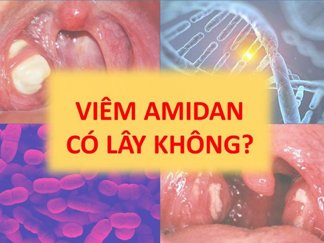 Viêm amidan có lây không