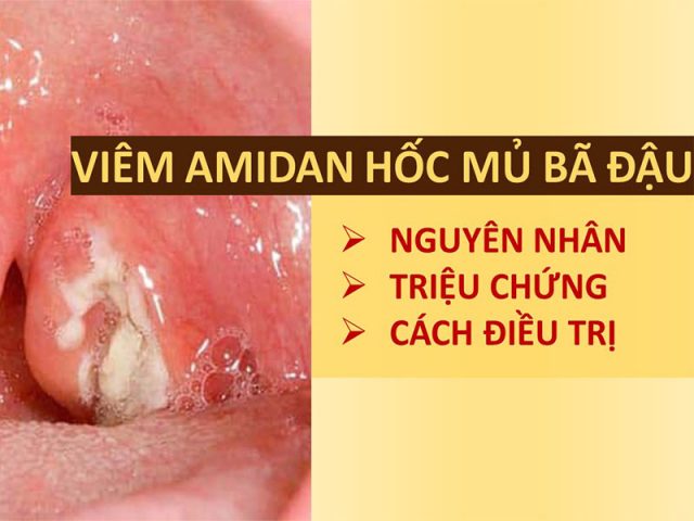 Viêm amidan hốc mủ bã đậu