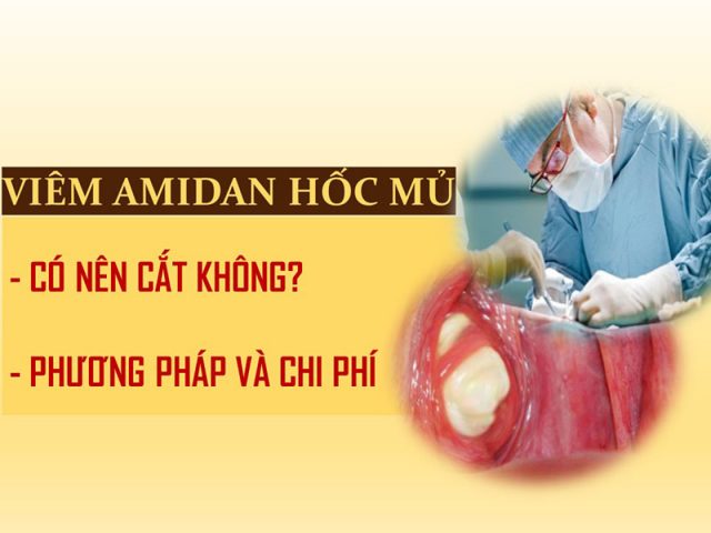 Viêm amidan hốc mủ có nên cắt không