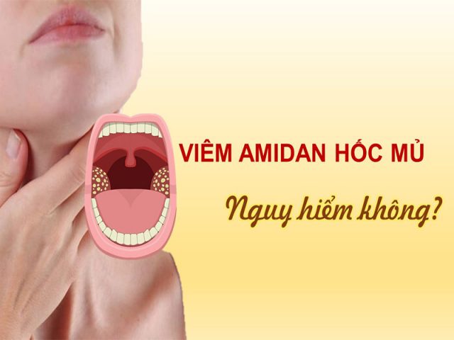 Viêm amidan hốc mủ nguy hiểm không