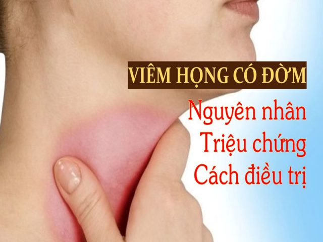 Viêm họng có đờm