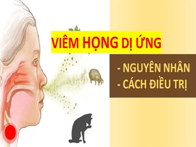 Viêm họng dị ứng