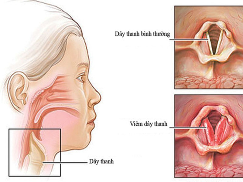 Viêm họng dị ứng có thể gây viêm thanh quản