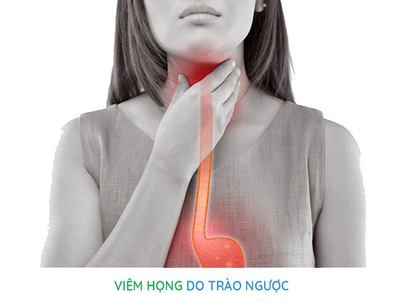 Viêm họng trào ngược dạ dày